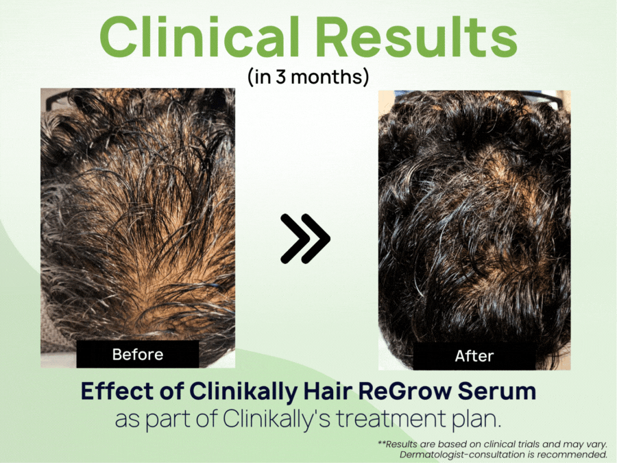 Get 70% off Advanced Hair Growth Serum (90 ml) 1 get 2 free