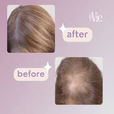 Get 70% off Advanced Hair Growth Serum (90 ml) 1 get 2 free