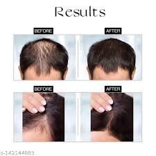 Get 70% off Advanced Hair Growth Serum (90 ml) 1 get 2 free